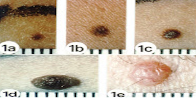 Stop Melanoma, check your skin regularly